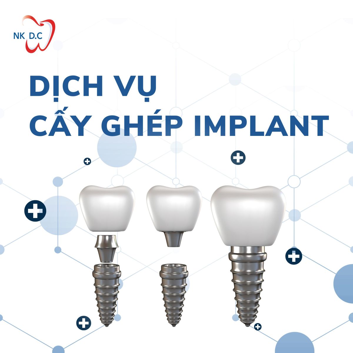 Cấy ghép Implant