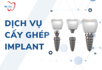 Dịch Vụ Cấy Ghép Implant
