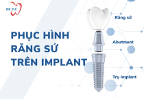 Phục Hình Trên Implant là gì? 