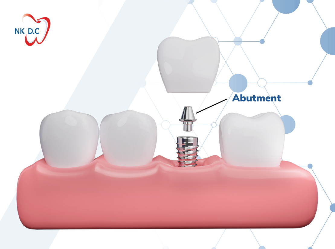 khớp nối Abutment