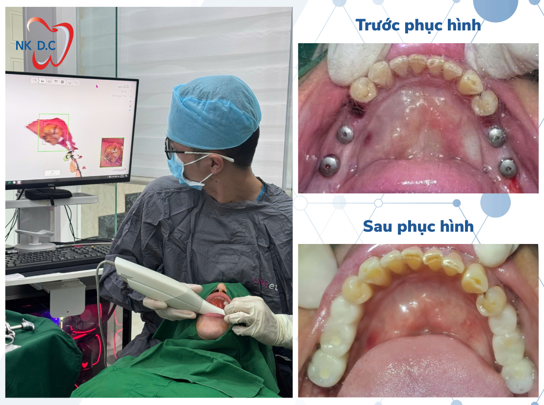 Phục hình trên Implant