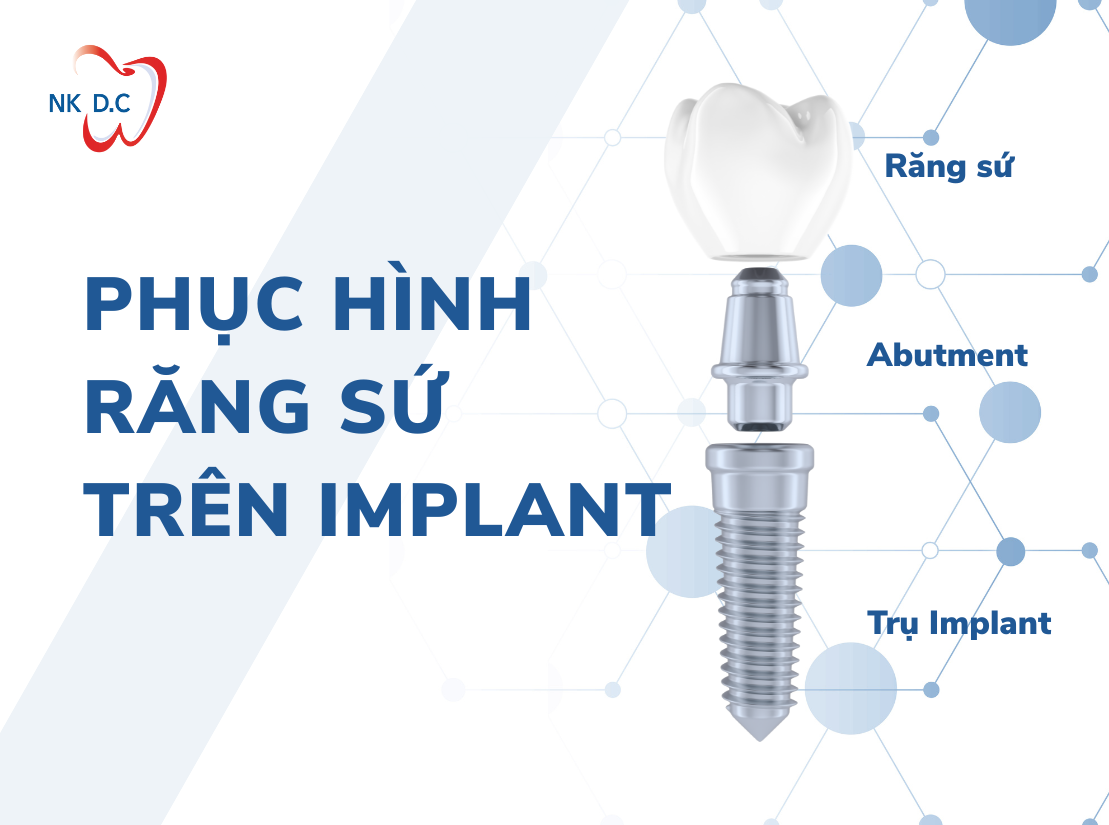 Răng sứ trên Implant